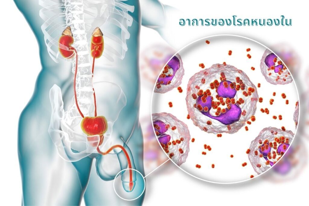 อาการของโรคหนองใน