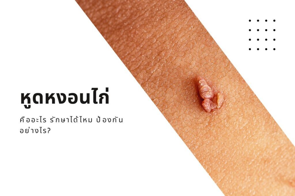 หูดหงอนไก่